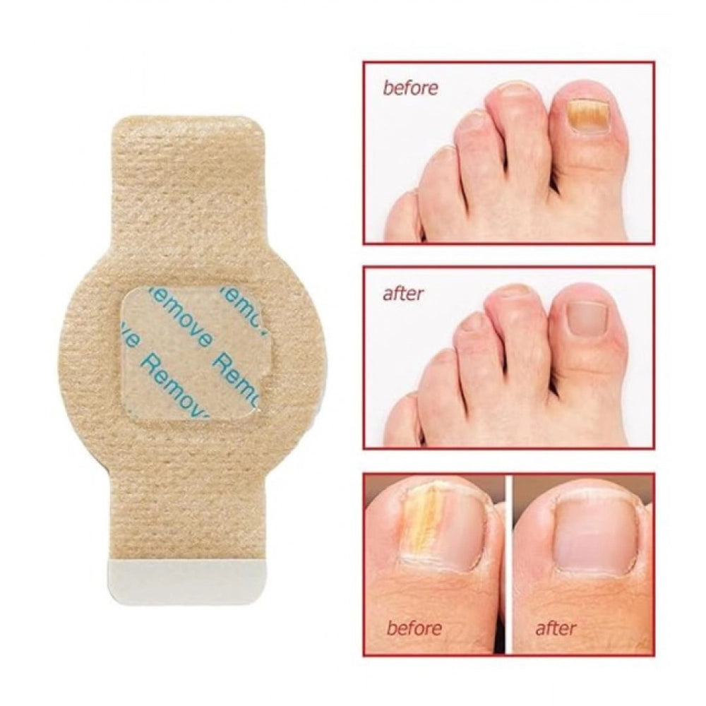 Fungal Nail Patches - Yellow
