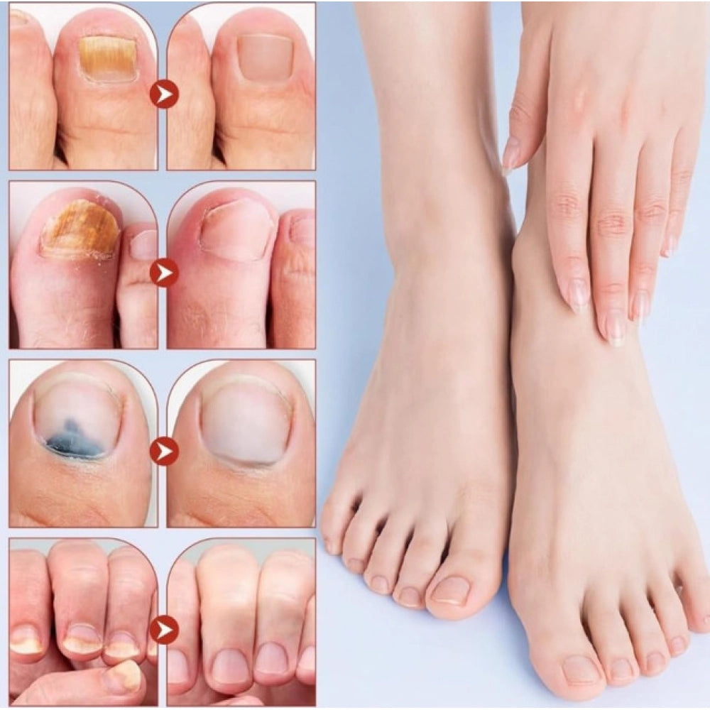 Fungal Nail Patches - Yellow